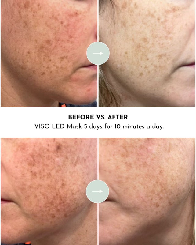 VISO FDA-Certified Red Light Therapy Face Mask – Medical-Grade LED Facial Rejuvenation System with Near-Infrared Technology